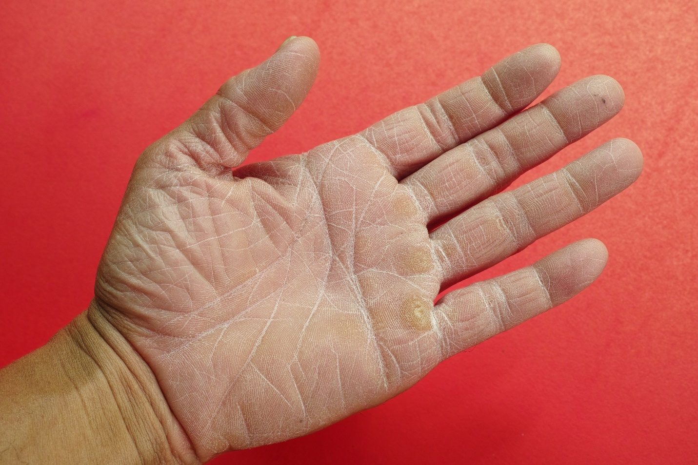 dry hands